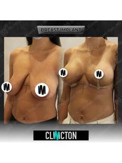 Breast Implants - Clinicton