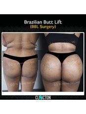 BBL - Brazilian Butt Lift - Clinicton