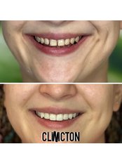 Smile Makeover - Clinicton