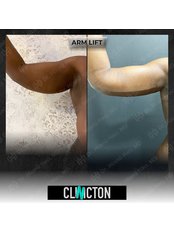 Arm Lift - Clinicton