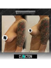 Breast Implants - Clinicton
