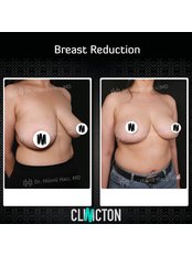 Breast Reduction - Clinicton