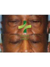 Eyelid Surgery - HealthDirect Clinics