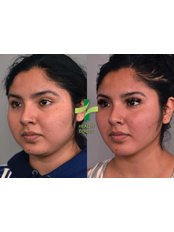 Buccal Fat Removal - HealthDirect Clinics