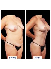 Breast Lift - Hoops World Tourism