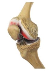 Knee Replacement - JFS Clinic