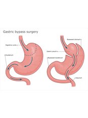 Gastric Bypass - JFS Clinic