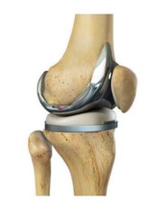 Knee Replacement - JFS Clinic