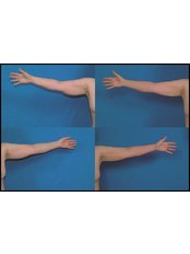 Arm Lift - JFS Clinic