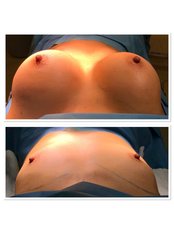 Breast Implants - MSM Health