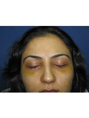 Eyelid Surgery - MSM Health
