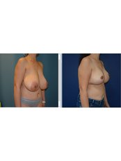 Breast Reduction - MSM Health
