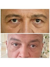 Brow Lift - Op. Dr. Ayse Oznur Akidil clinic