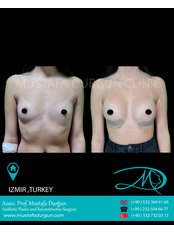 Breast Implants - Prof. Dr. Mustafa Durgun Clinic