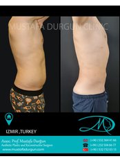 Liposuction - Prof. Dr. Mustafa Durgun Clinic