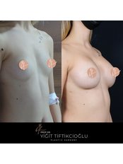 Breast Implants - Prof.Dr. Yigit Tiftikcioglu Clinic