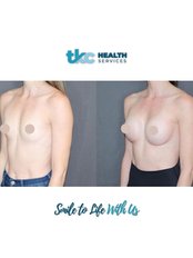 Breast Augmentation - TKC Health Services