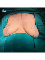 Breast Implant Revision - TKC Health Services