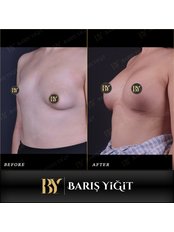 Breast Lift - Baris Yigit Aesthetic & Plastic Surgery Clinic