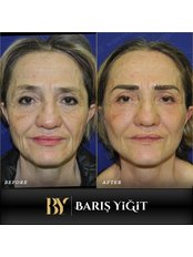 Facelift - Baris Yigit Aesthetic & Plastic Surgery Clinic