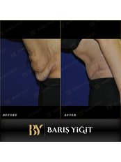 Tummy Tuck - Baris Yigit Aesthetic & Plastic Surgery Clinic