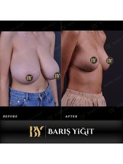 Breast Reduction - Baris Yigit Aesthetic & Plastic Surgery Clinic