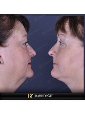 Facelift - Baris Yigit Aesthetic & Plastic Surgery Clinic