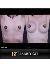 Breast Implants - Baris Yigit Aesthetic & Plastic Surgery Clinic