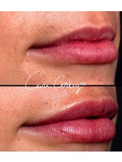 Lip Augmentation - Renovium Clinic (Cem Cerkez MD)
