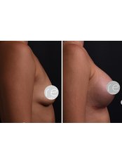 Breast Implants - Renovium Clinic (Cem Cerkez MD)