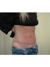 Tummy Tuck - Bristol Cosmetic Surgery - Chesterfield Nuffield Hospital