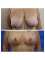 Breast Reduction - Canova Medical