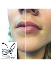 Lip Augmentation - Canova Medical