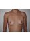 Dr Foued Hamza - Queen Anne Street London - Breast Fat Transfer before 