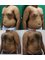 Reforme Medical - Cardiff - Microcannalicular liposuction chest tummy and love handle 