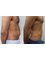 Reforme Medical - Cardiff - Microcannalicular liposuction tummy and love handle 