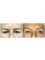 MACS Cosmetic Clinic (Watford) - Upper eyelid reduction 