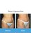Liverpool Private Hospital - Vaser Liposuction Before & After  