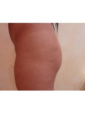 Butt Implants - Harley Buttock Clinic