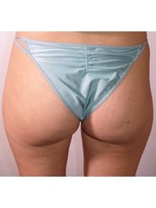 Buttock Injections - Harley Buttock Clinic