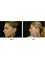 MACS Cosmetic Clinic (Harley Street) - Correction of prominent ears 