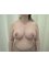 Navid Jallali - Breast reduction After 