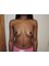 Navid Jallali - Subglandular breast augmentation before 