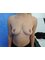 Navid Jallali - Mastopexy/Breast uplift After 