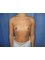 Navid Jallali - Dual plane Breast augmentation before 