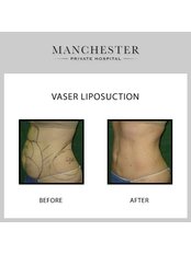 VASER Lipo™ - Manchester Private Hospital - London