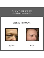 Eyelid surgery - Manchester Private Hospital - London