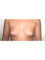 Breast Implants - Aset Hospital Cosmetic Surgery