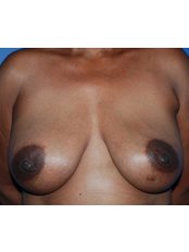 Breast Implant Revision - Harley Plastic Surgery
