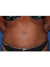 Thigh Liposuction - Harley Plastic Surgery